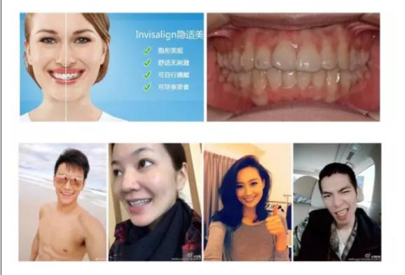 牙齿矫正有几种方式,牙齿矫正刷牙方式视频