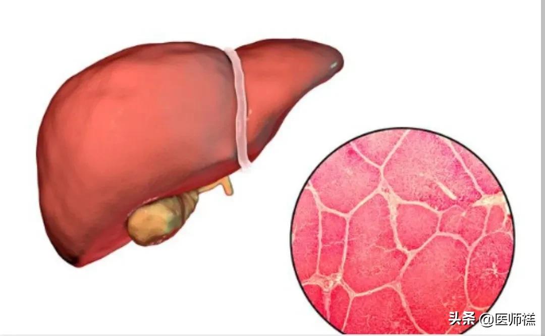 阿司匹林预防心血管,阿司匹林预防心脏的副作用与危害