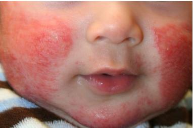 皮炎湿疹荨麻疹外用药膏,皮炎湿疹止痒口服药