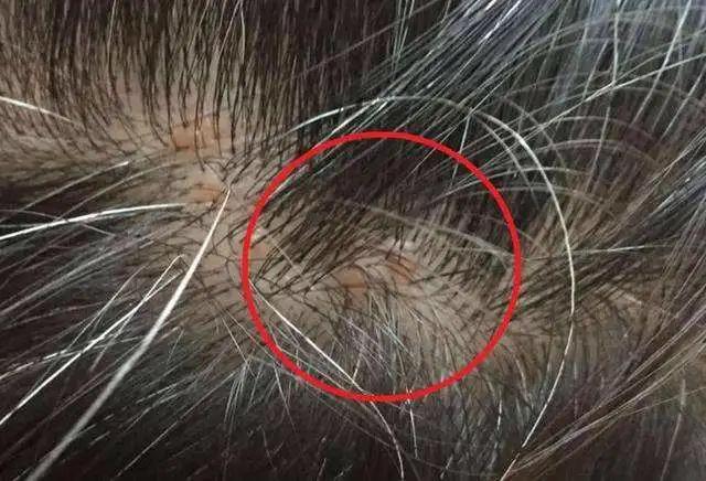 头皮屑多怎么根除最简单方法,如何彻底根治头皮屑的方法