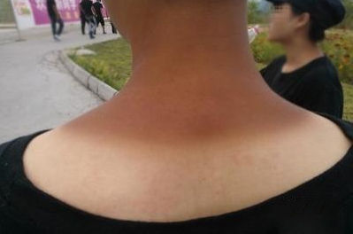 脖子被太阳晒黑了怎么才能变白,被太阳晒黑怎样变白女生