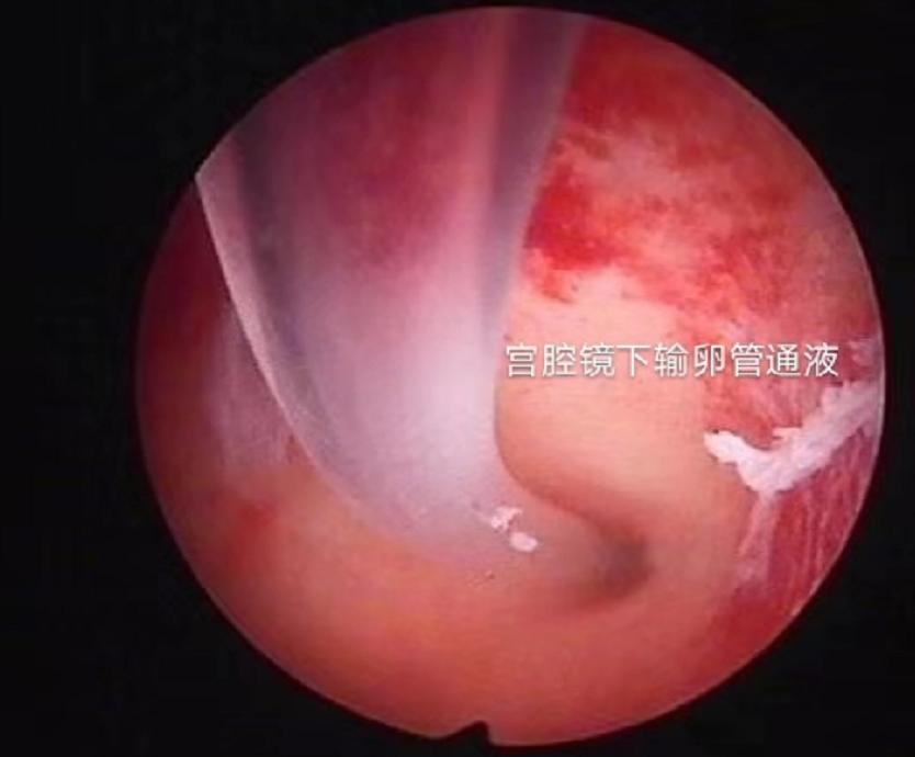 治好不孕送锦旗,多年顽疾终治愈敲锣打鼓送锦旗