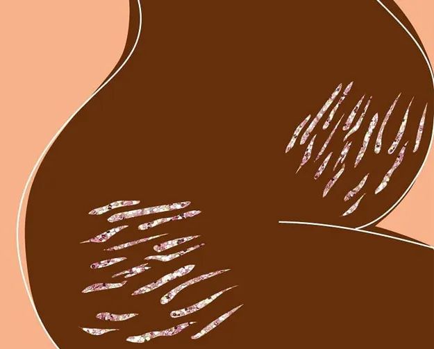 擦油真的能预防妊娠纹吗,预防妊娠纹的油是智商税吗