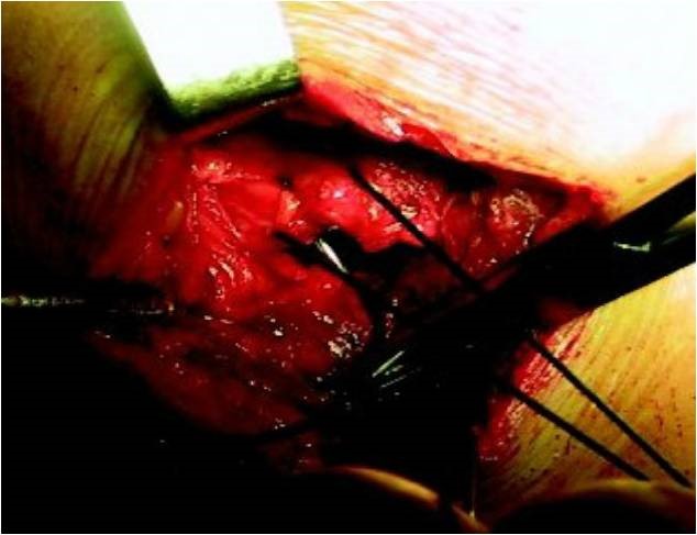 肩袖损伤要怎么处理,肩袖损伤专用膏药