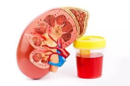 激素治痛风急性发作期的效果真好,激素治疗痛风伤肾