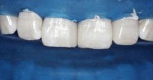 门牙缝可以补吗,门牙有缝怎么办如何补救