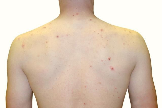 夏天来了祛痘痘,夏天来了长痘痘了怎么办