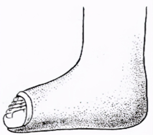 孩子足外翻该怎么办,孩子足外翻是怎么回事