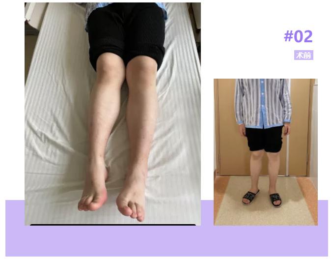 骨盆倾斜导致长短腿严重会怎样,长短腿骨盆倾斜