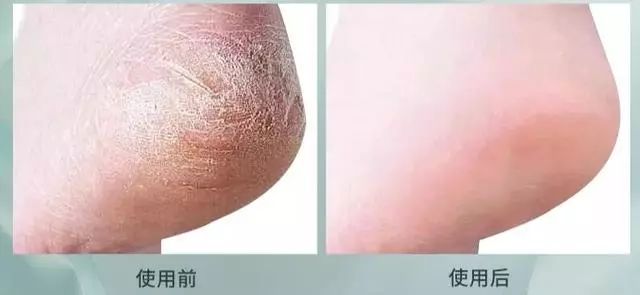 手脚干裂皮肤又厚又痒怎么办,冬天手脚干裂起皮怎么治疗