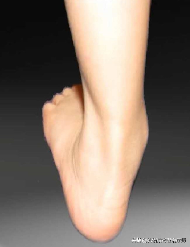 如何治疗足底筋膜炎缓解疼痛,足跟痛筋膜炎最佳的治疗办法