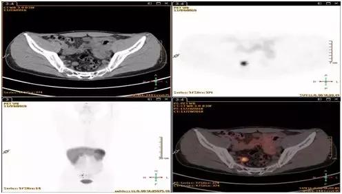 直肠神经内分泌肿瘤分级和治疗,直肠神经内分泌肿瘤到底是不是癌