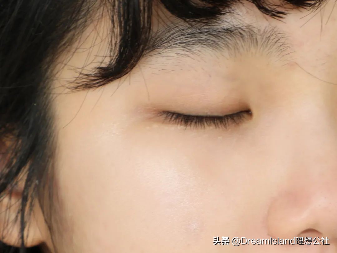 玻尿酸高光排名,打玻尿酸高光推荐