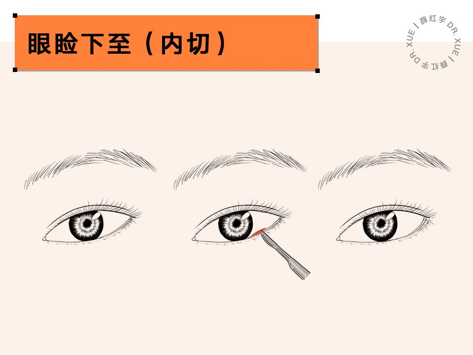 要不要开下眼睑,要不要开内眦赘皮