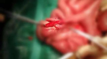 宝宝蛋白过敏为什么便血,宝宝便血的过敏源