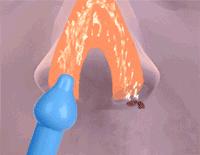 婴幼儿一招止鼻塞流清鼻涕,儿童鼻塞有黄鼻涕一招解决