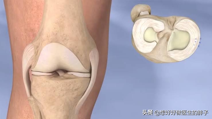 半月板缝合术后膝盖肿胀怎么消除,半月板缝合术后肿胀正常吗