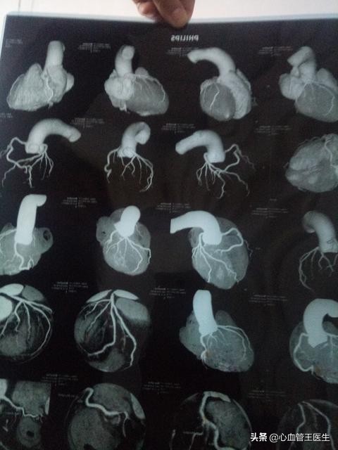 心脏血管狭窄25%最好的治疗方法,心脏血管狭窄30%以后会不会更严重