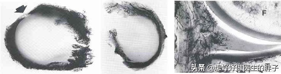 为什么足球运动员不会半月板受伤,半月板伤病对足球运动员影响大吗