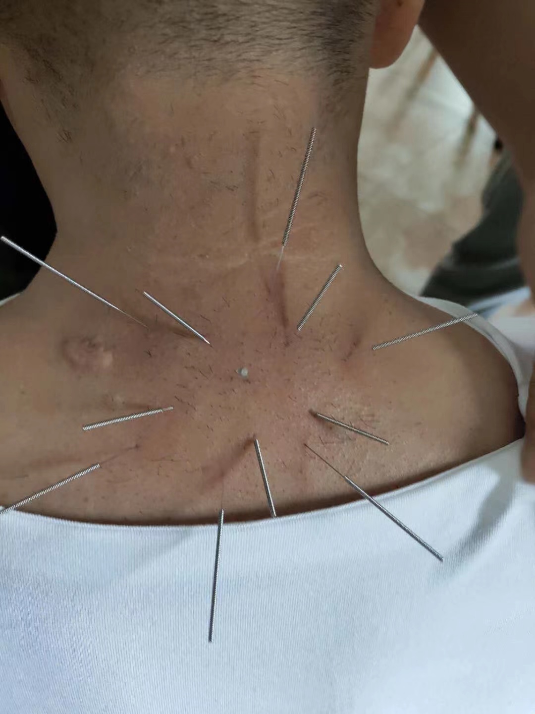 中医针灸治疗颈椎病原理,颈椎病针刀按摩针灸哪种方法好