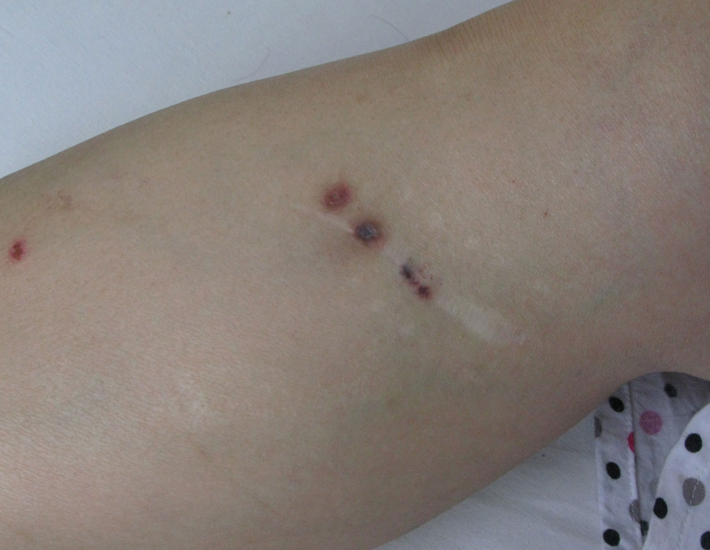 河南哪家医院祛疤最好,河南疤痕科医院排名