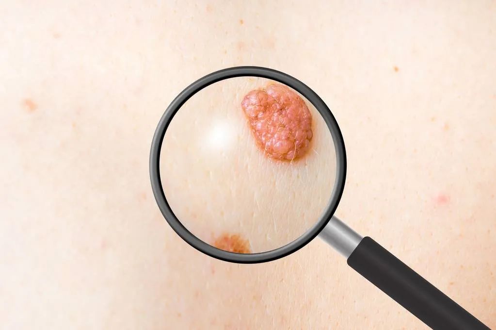 脸上长了很多痣是不是肝癌,这种痣可能是肝癌信号