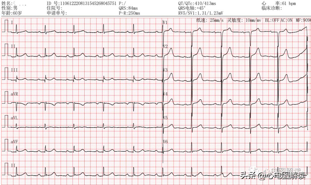 房室阻滞有什么症状,一度房室传导阻滞