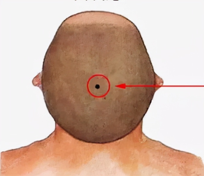 痣一旦有变化就是癌变吗,痣发生癌变时会有3种表现