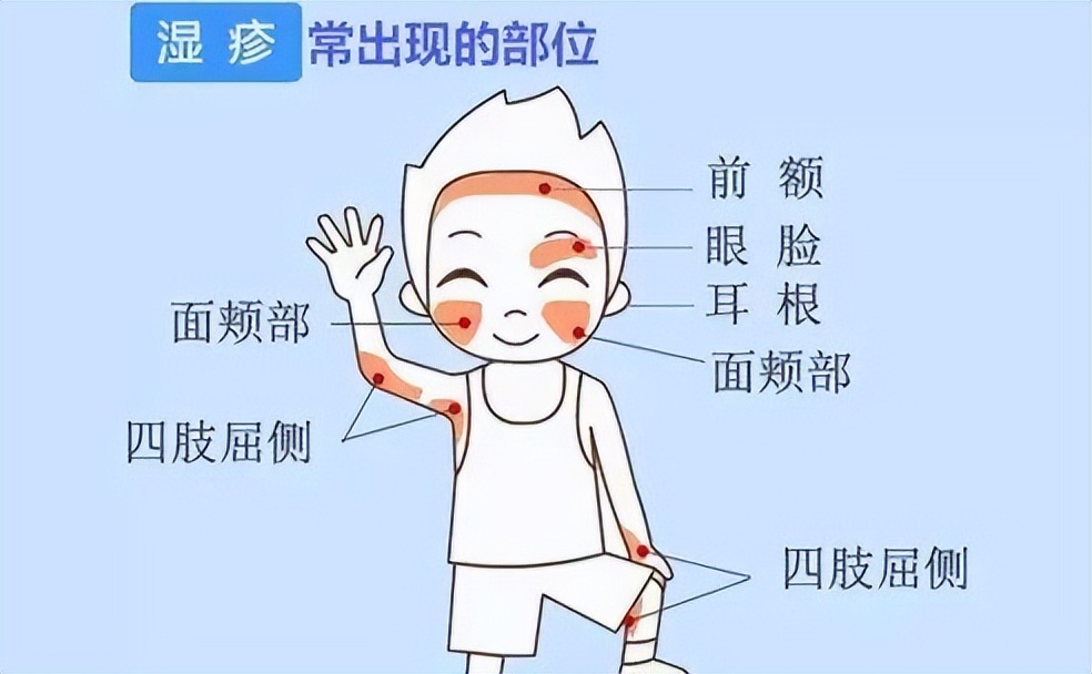 得了湿疹如何快速治疗,得了湿疹最佳治疗方法