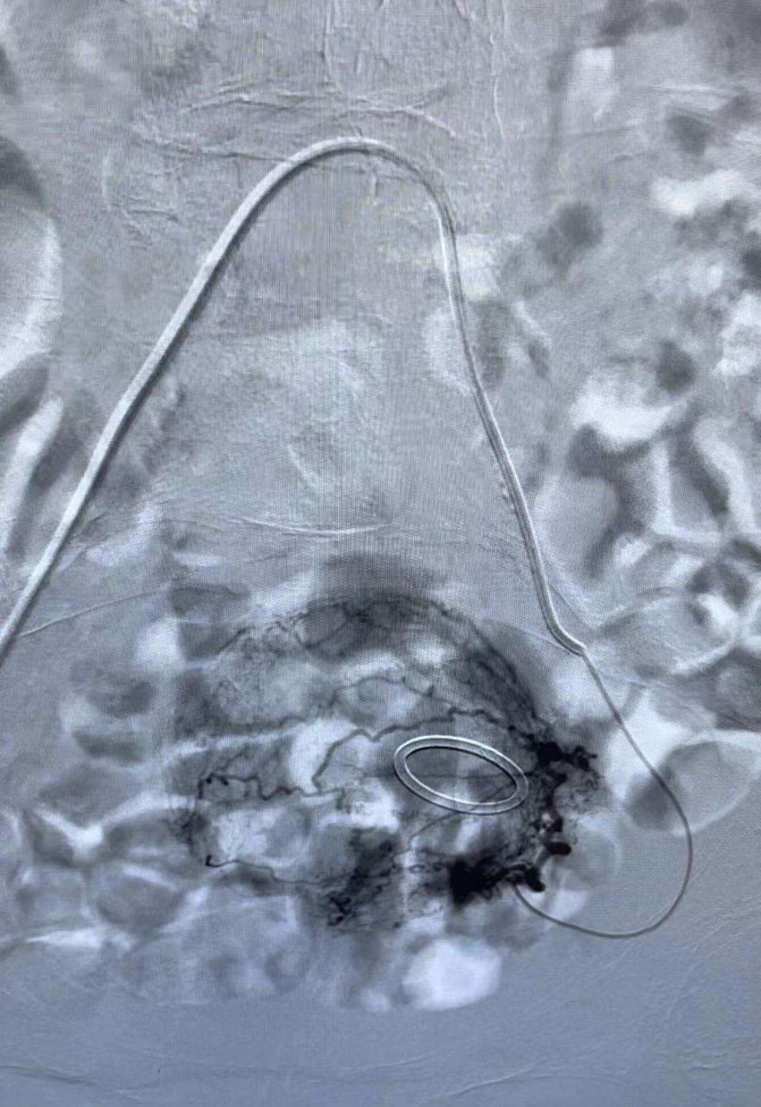 mdt治肿瘤效果怎么样,宫颈癌化疗血小板低拉血不止