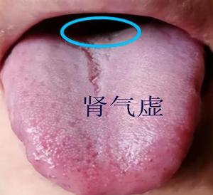 舌根部有裂纹是什么舌象,舌有裂纹7种原因通过舌象来调理