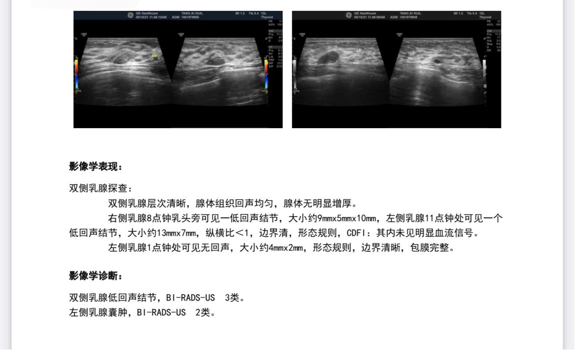 医案分享||查出乳腺结节千万别急着做手术,予你一剂良方击碎肿块