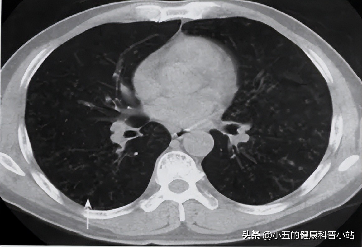 乙酰半胱氨酸治疗慢性支气管炎吗,乙酰半胱氨酸片直接口服