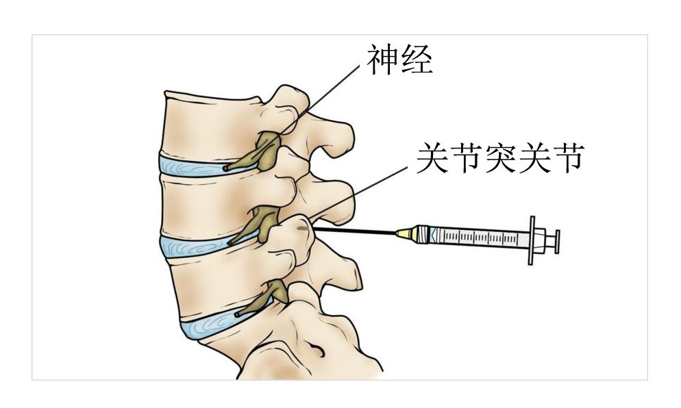 腰痛原因讲解,腰痛康复科普文章内容