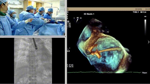 二尖瓣狭窄病例分享,二尖瓣病理生理及治疗方法