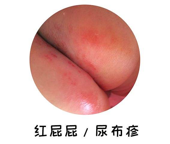 新生儿四种疹子,新生儿四种表现