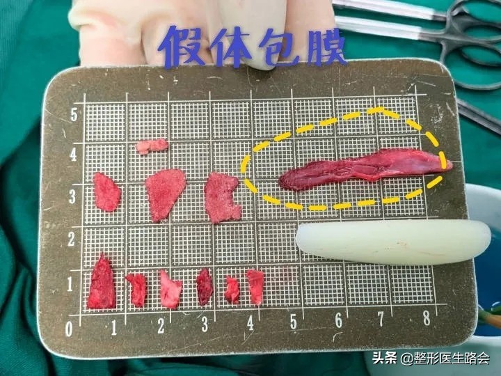 十年隆鼻什么情况下需要重做,10年歪鼻子能修复吗