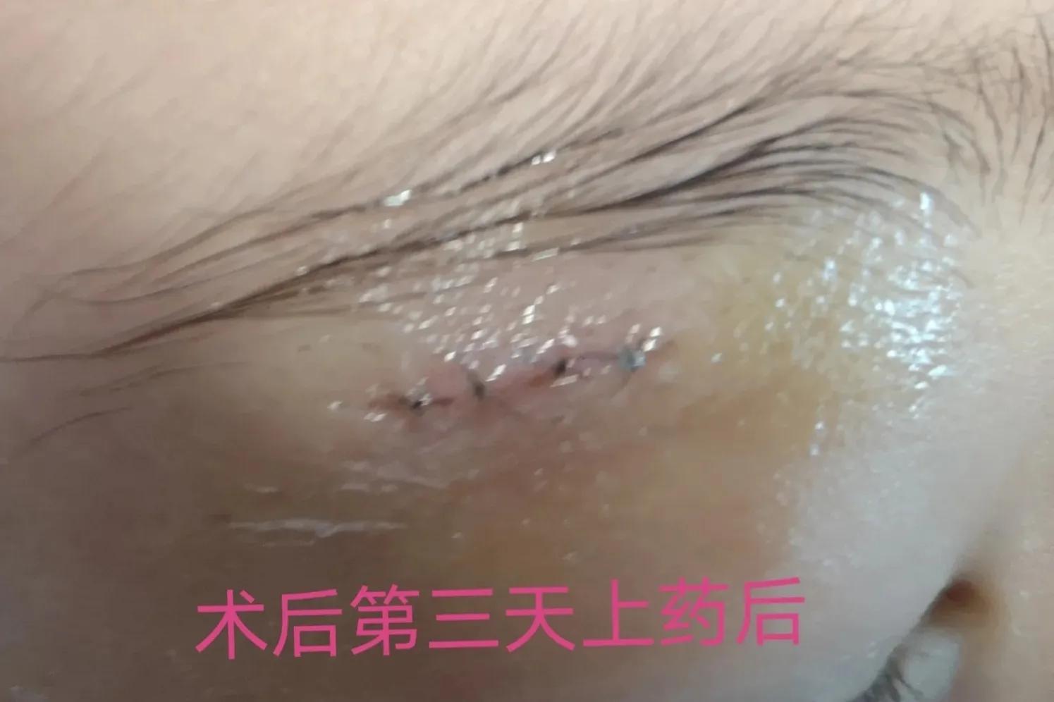 皮脂腺囊肿和粉刺瘤,火针治疗皮脂腺囊肿