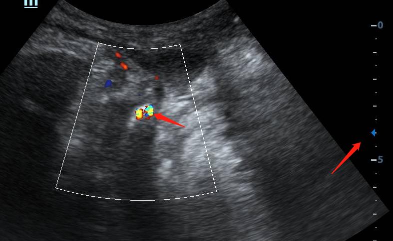 八十岁老爷爷小便尿不出来,85岁老人小便拉不出来是怎么回事