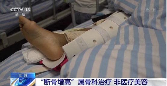 李亚诺断骨手术,断骨增高7.2厘米的李亚诺现状