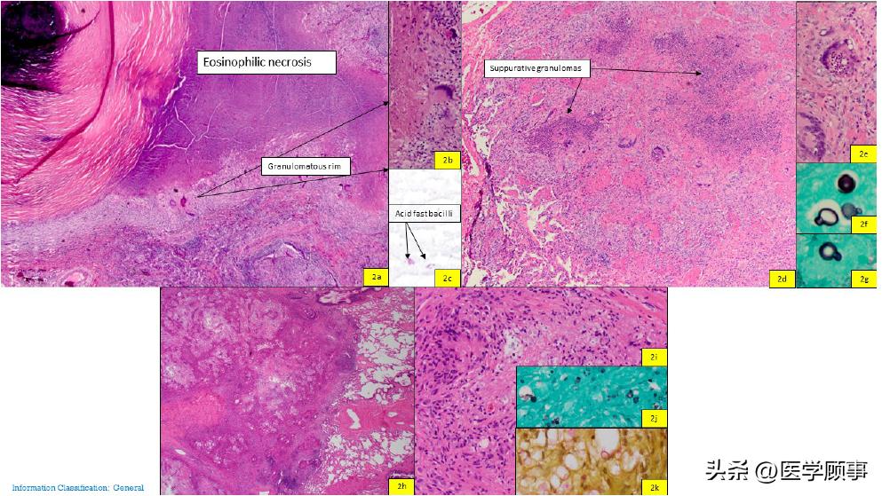 肺结核性肉芽肿是肺病吗,肺肉芽肿是不是癌症