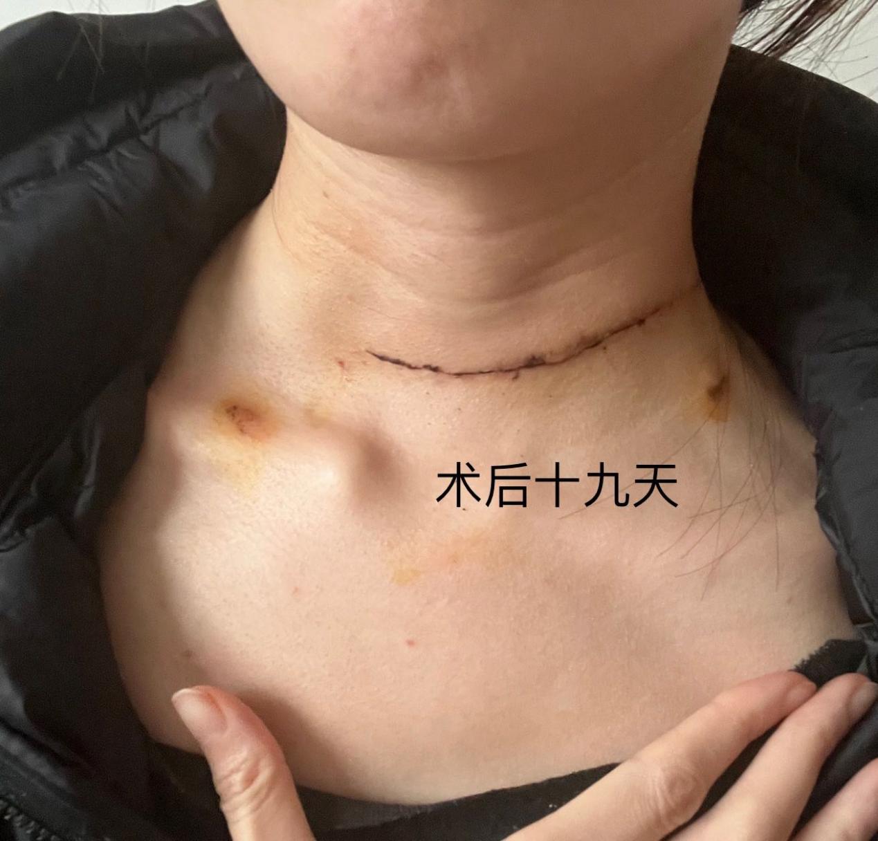 甲状腺癌手术全切疤痕多久能消除,甲状腺癌全切手术后的真实感受