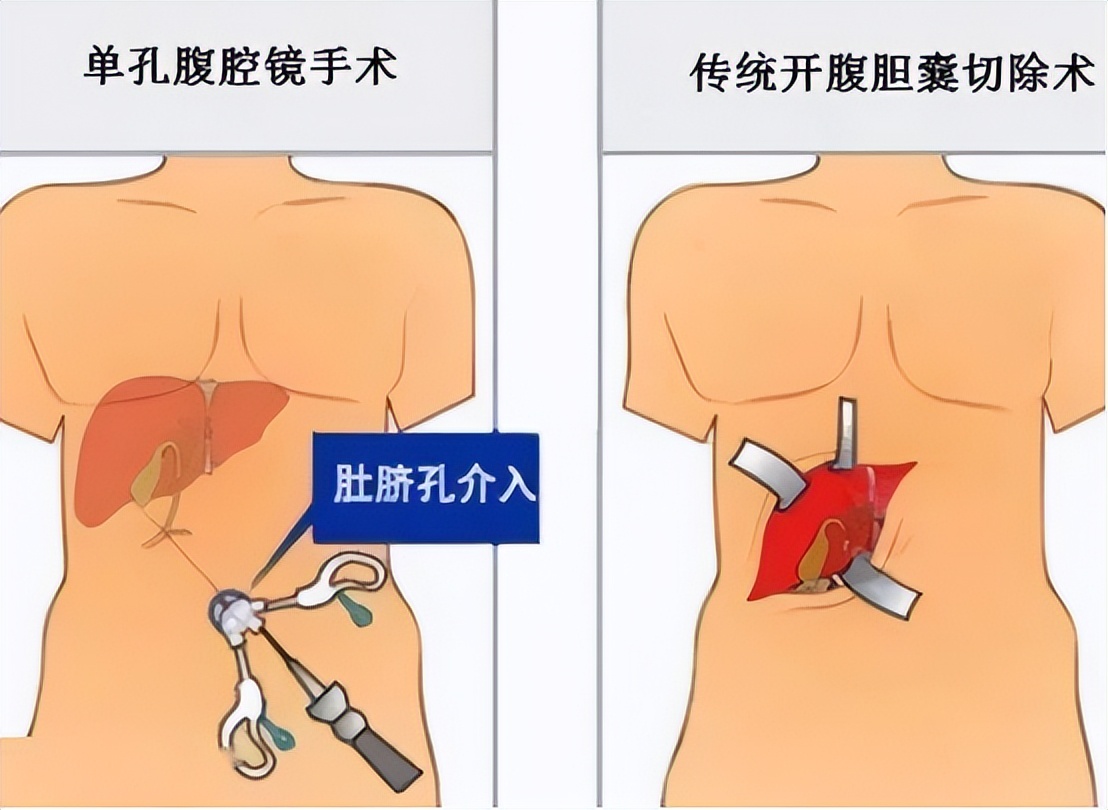 急性胆囊炎发作的原因有哪些,急性胆囊炎的症状及治疗都有哪些