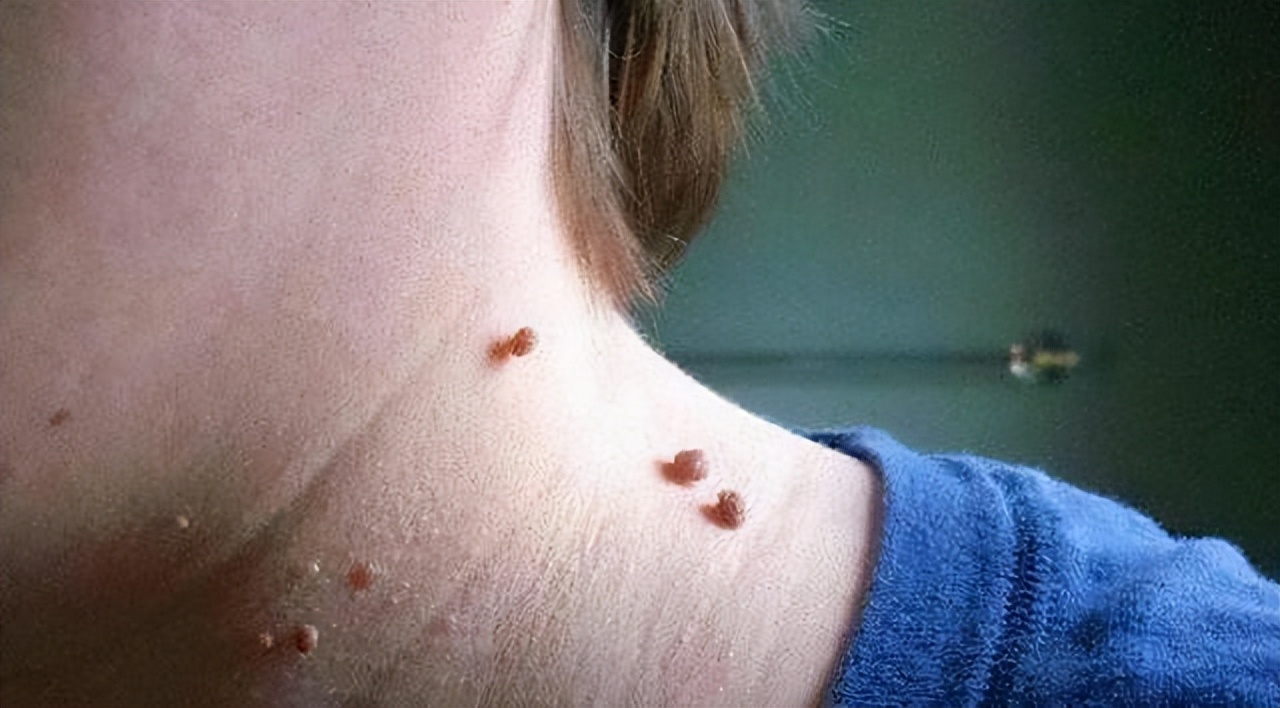 皮肤下长了小肉球如何去除,皮肤长小肉球用什么药膏