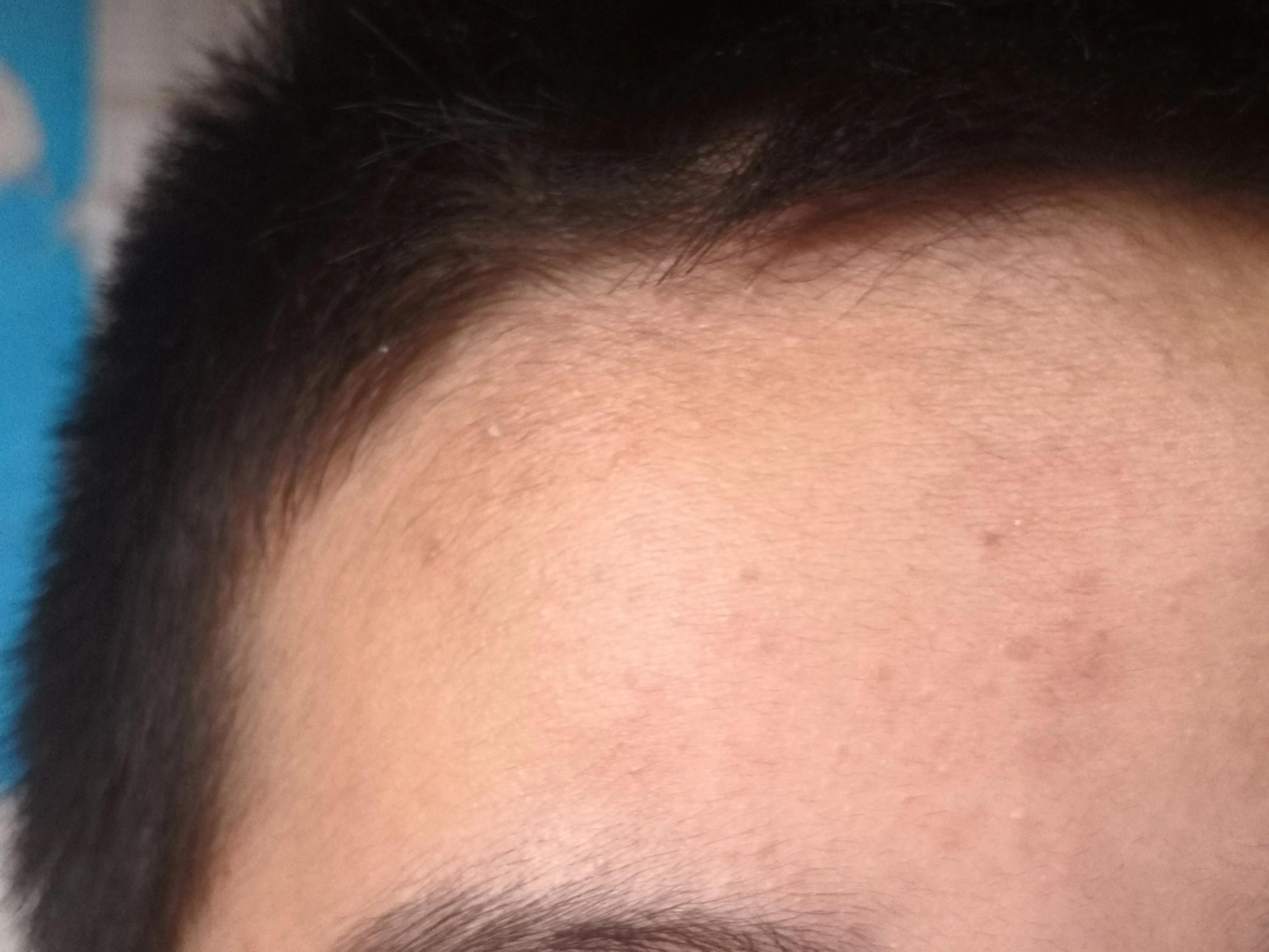 偶然发现对付青春痘的特强面霜，太管用了