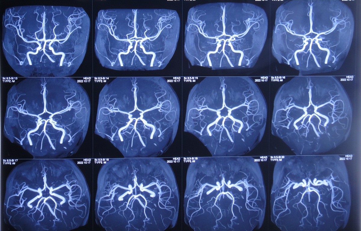 脑干出血儿童,儿童脑干胶质瘤呕吐
