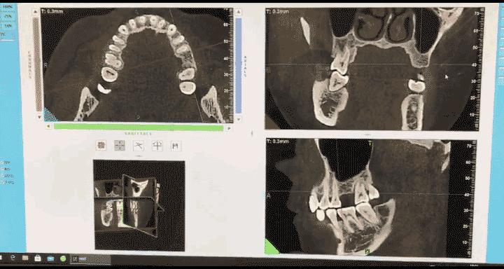 牙齿掉了对其他的牙齿有影响吗,牙齿掉了三个月没有出牙