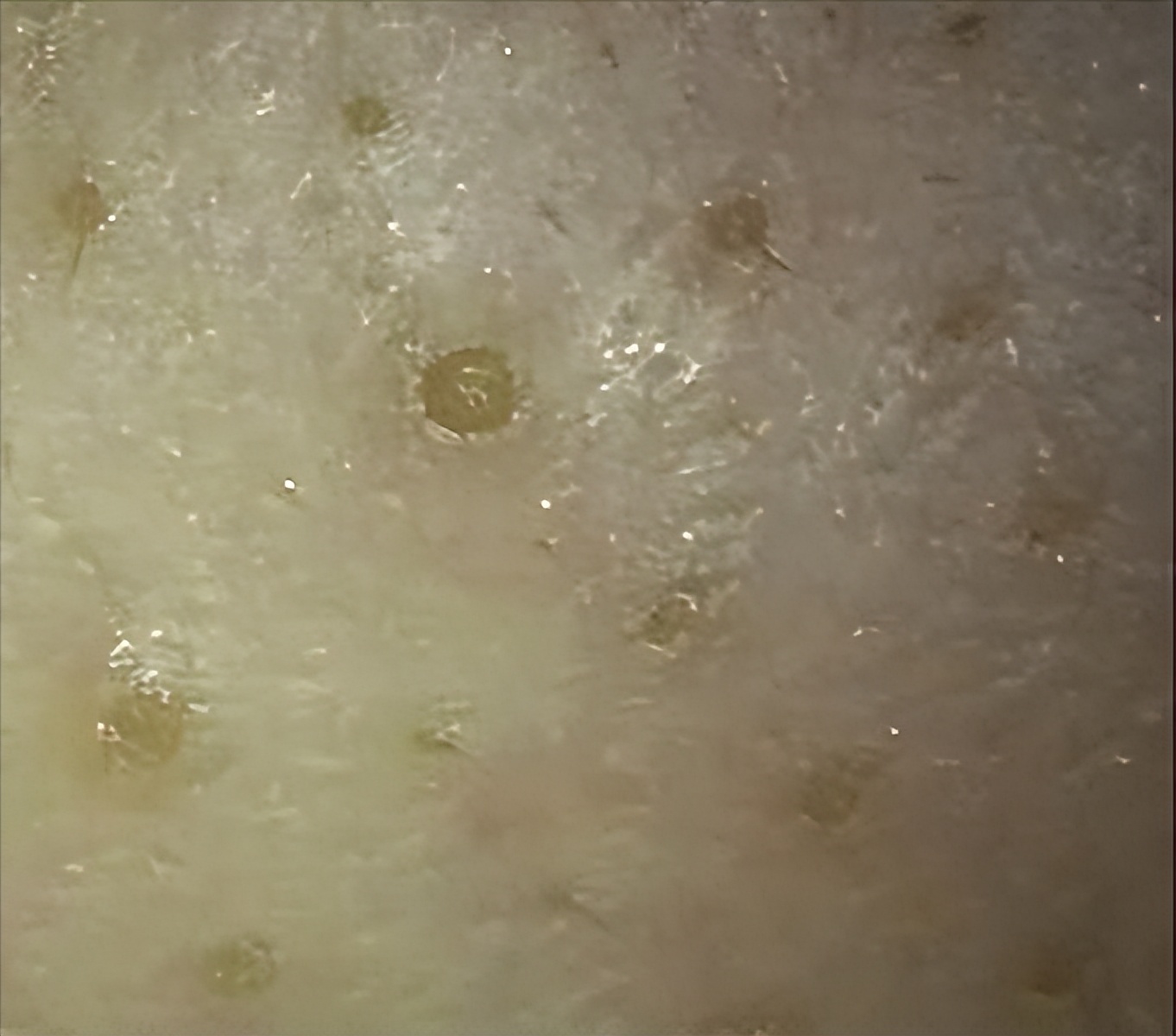 毛孔堵塞毛孔发黑怎样清理,毛孔长螨虫堵塞毛孔怎么办