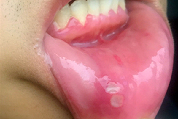 为啥0.4毫克的叶酸比5毫克的贵,0.4毫克和5毫克叶酸有啥区别