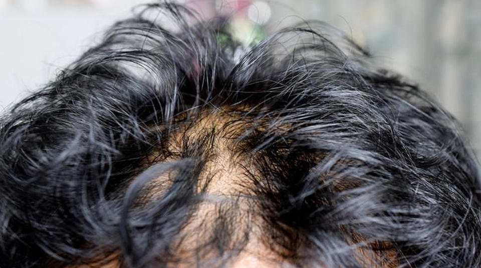 植物染发馆：你的头发容易油，可能是螨虫在作祟